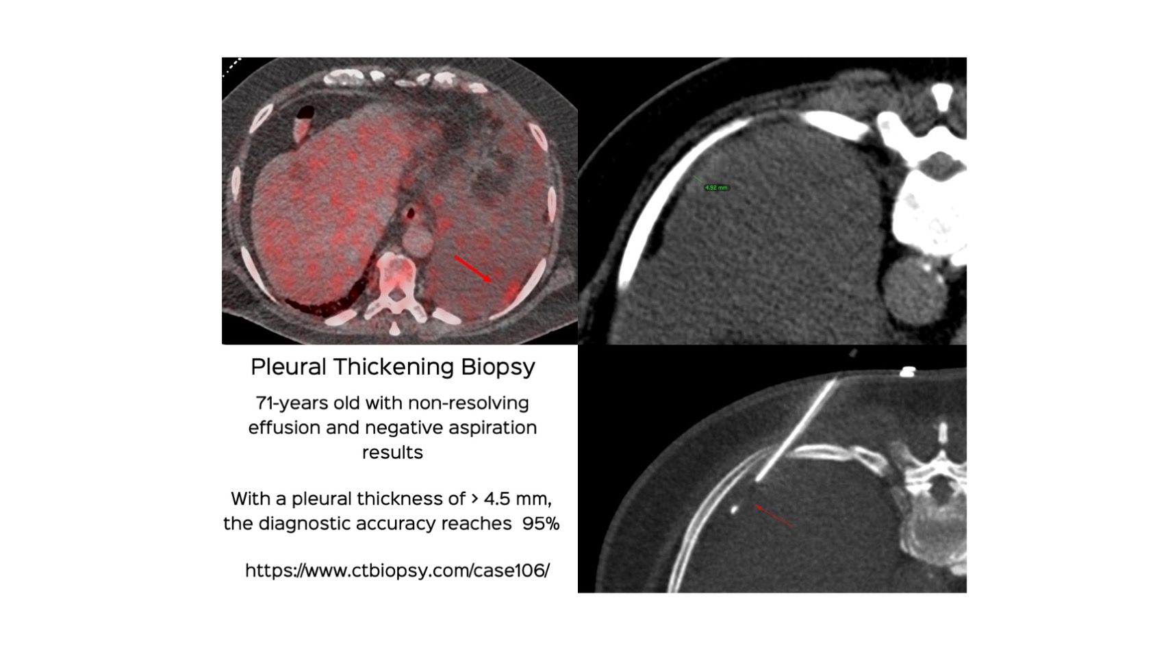 Case 106: Pleural Thickening Biopsy