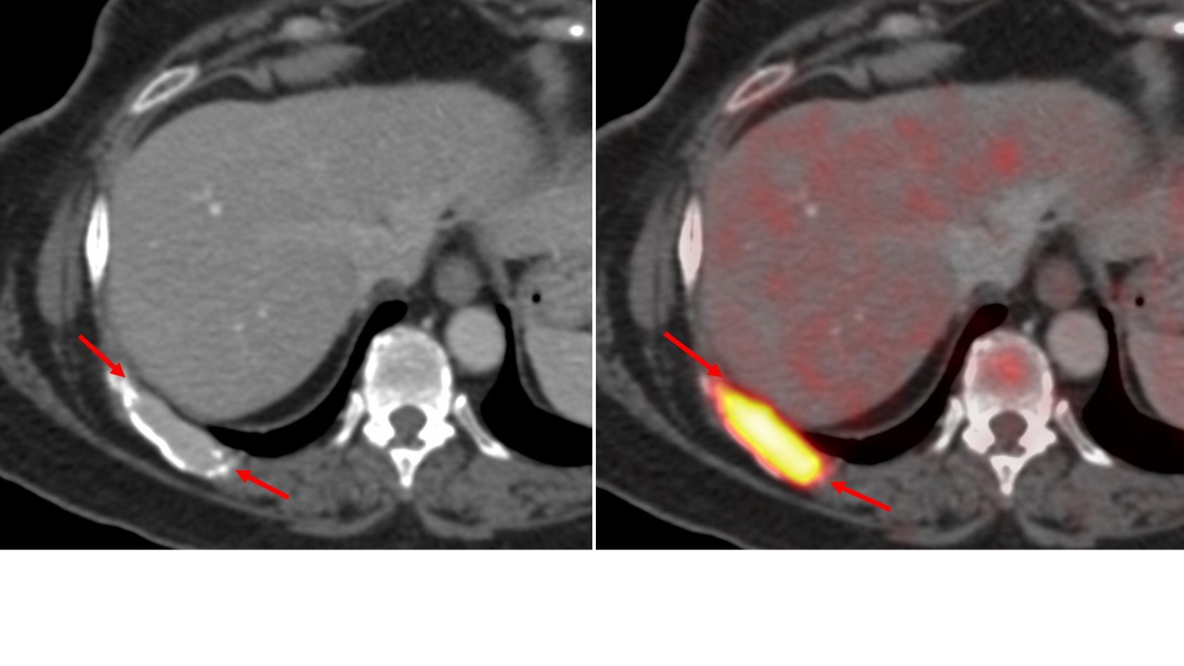 Case 105: Rib Lesion Biopsy - Along the Long Axis