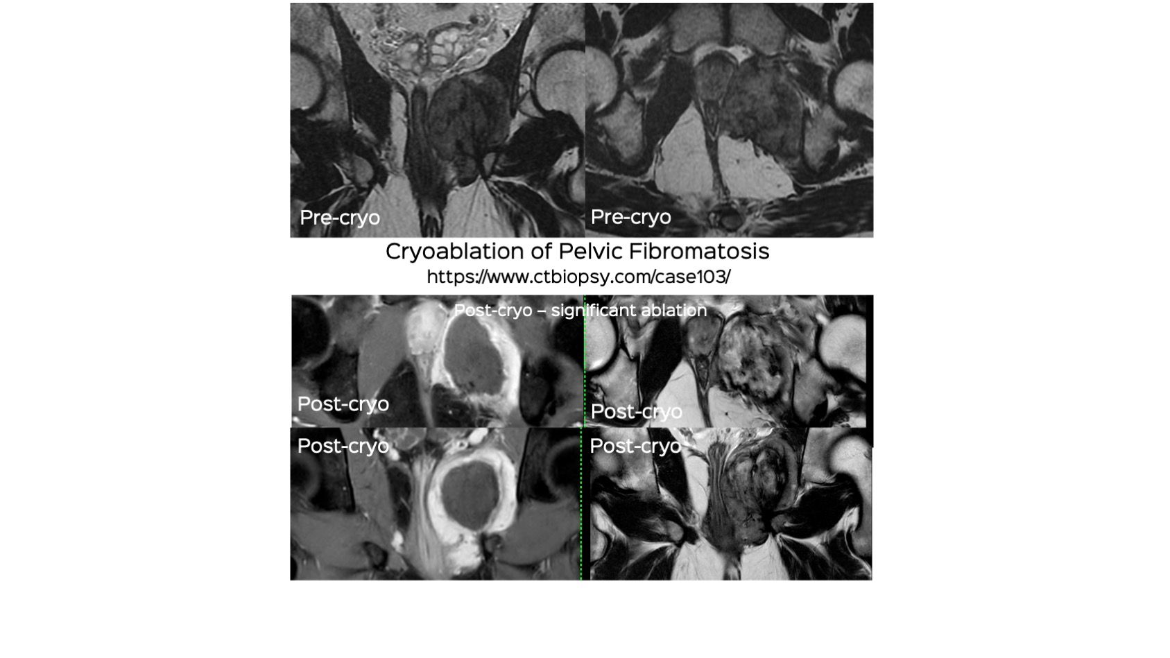 Case 103: Cryoablation of Pelvic Fibromatosis