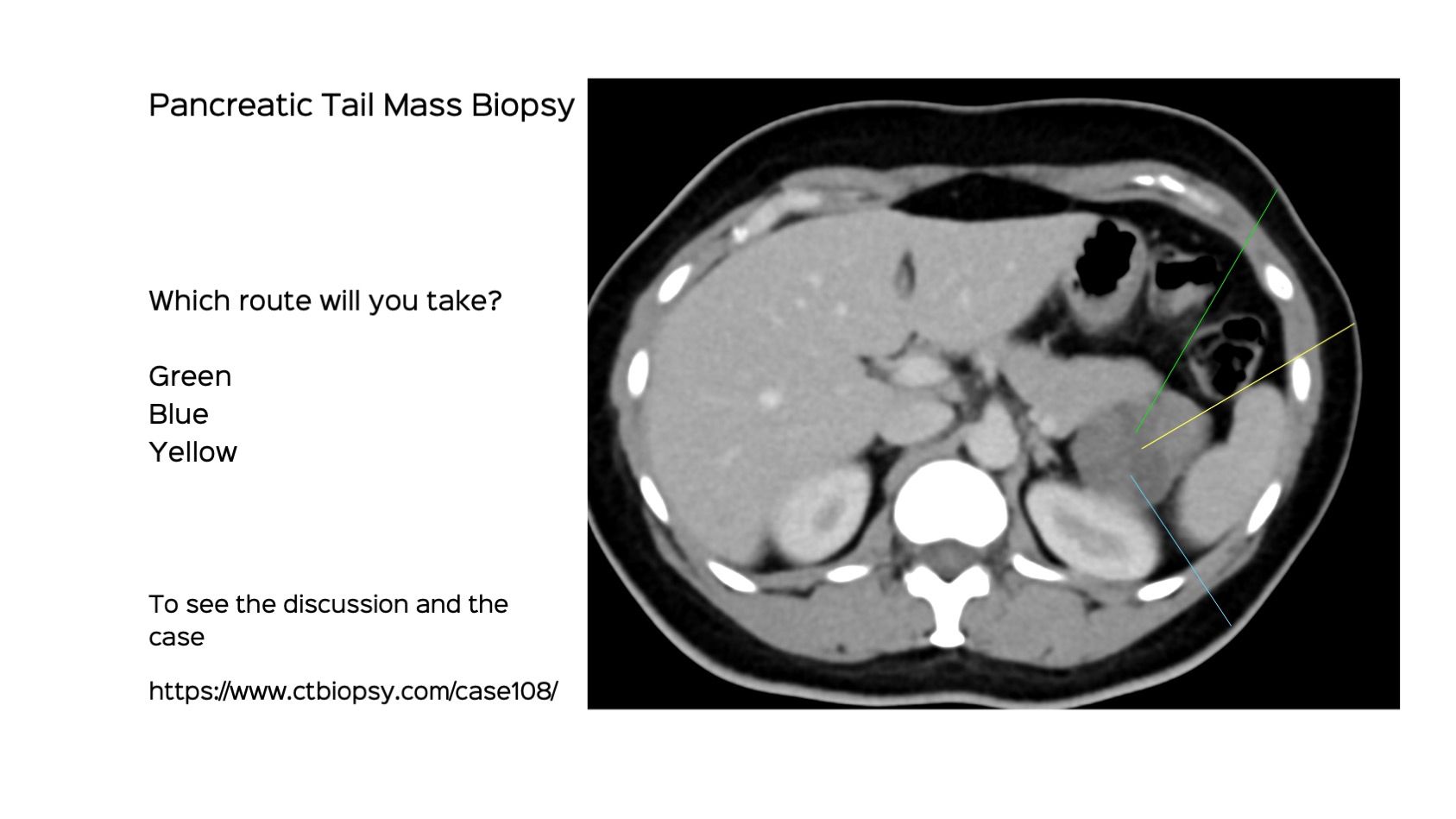 Case 108: Pancreatic Tail Lesion Biopsy