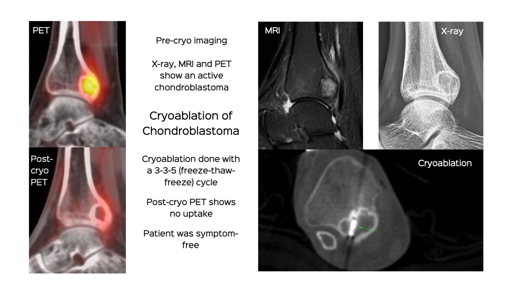 Case 107: Cryoablation of Chondroblastoma
