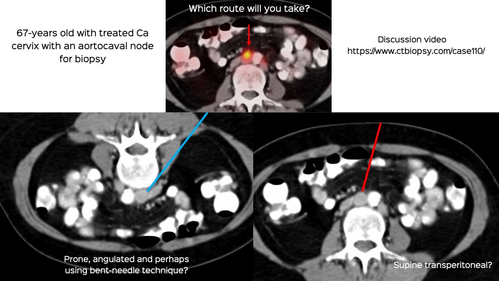 Case 110: Retroperitoneal Aortocaval Node Biopsy