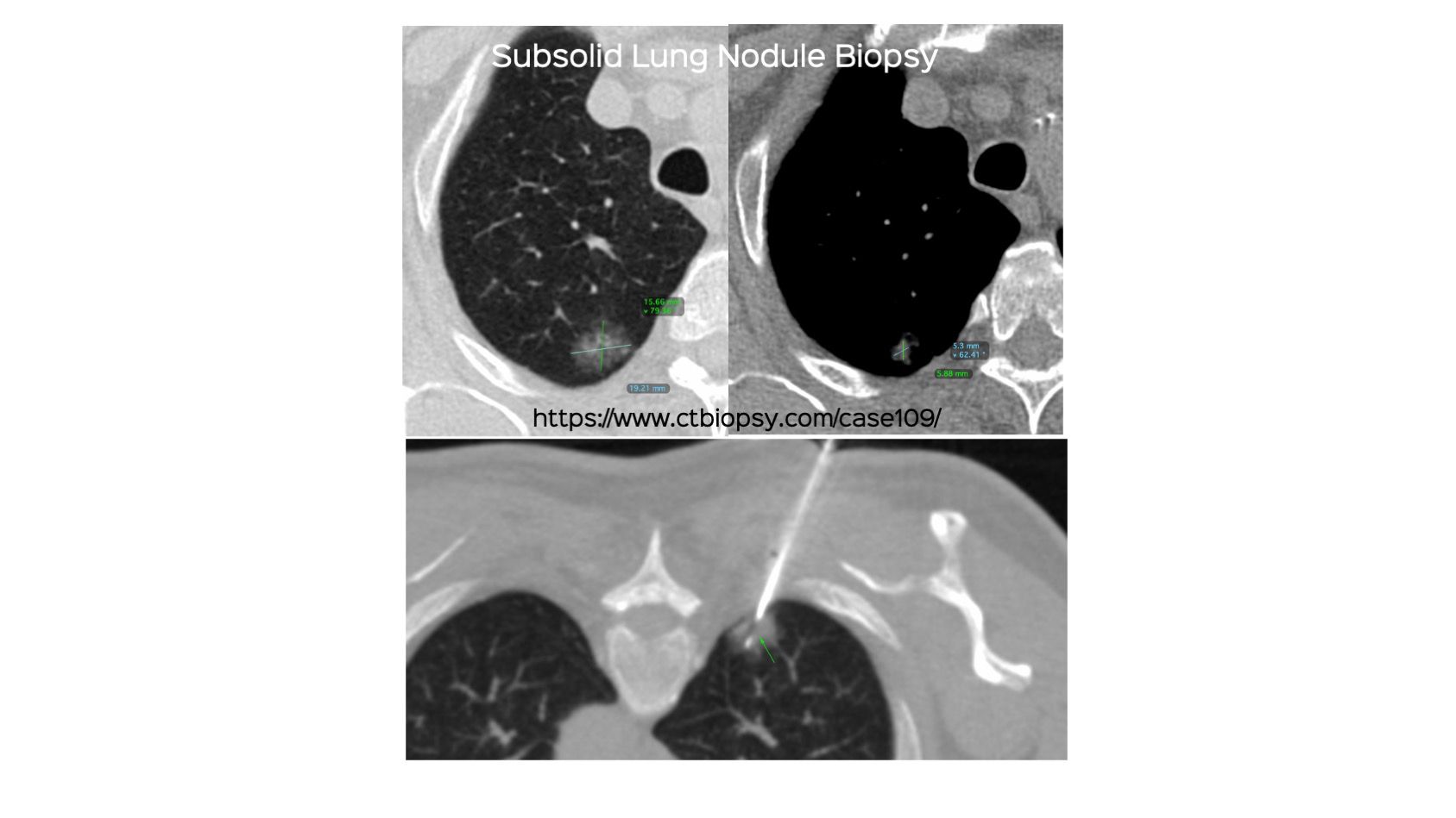 Case 109: Subsolid Lung Nodule Biopsy