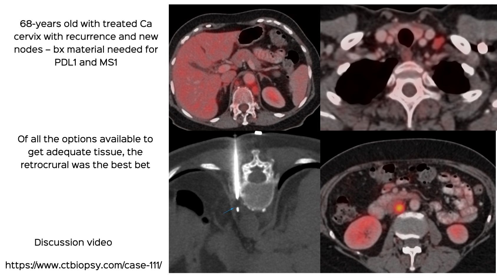 Case 111: Retrocrural Node Biopsy