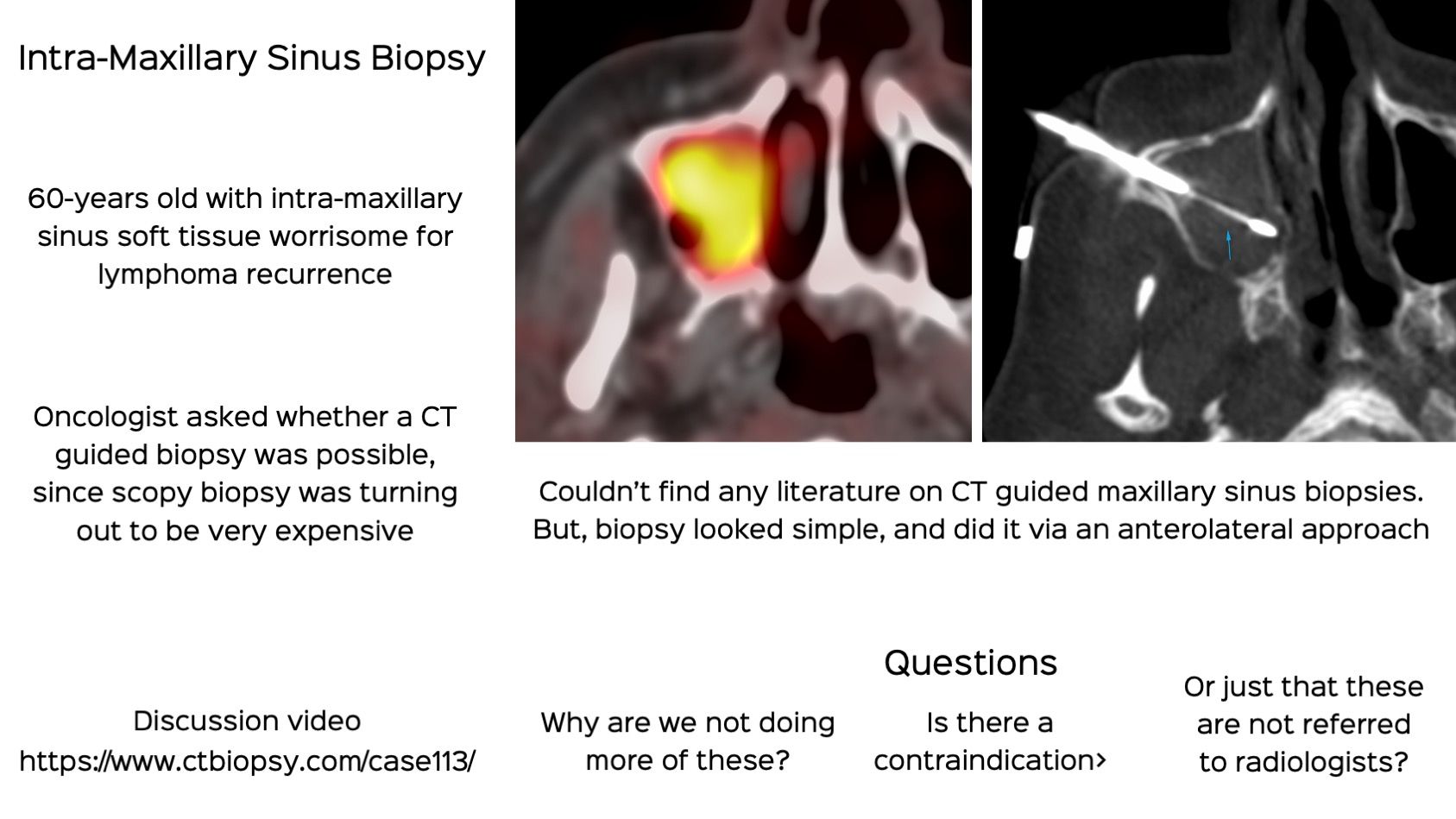 Case 113: Intra-Maxillary Sinus Biopsy