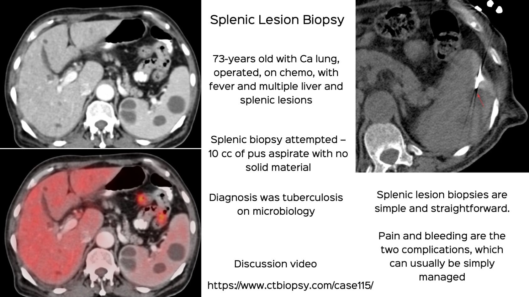 Case 115: Splenic Lesion Biopsy