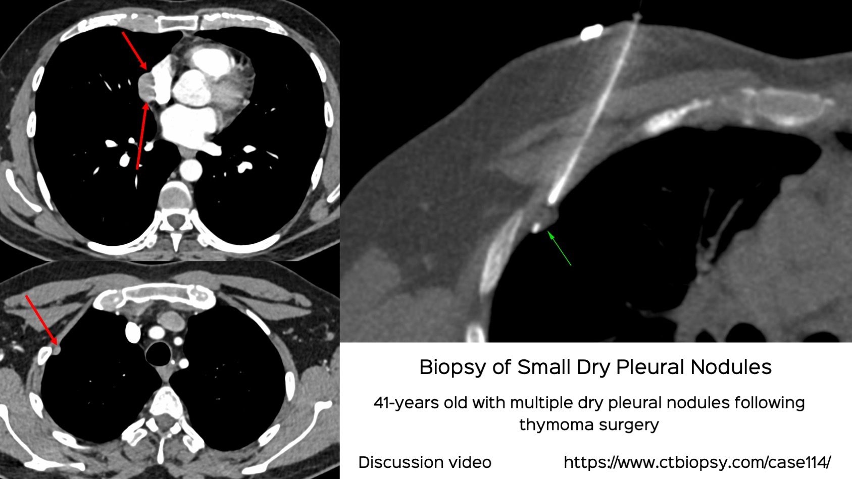 Case 114: Small Dry Pleural Nodule Biopsy