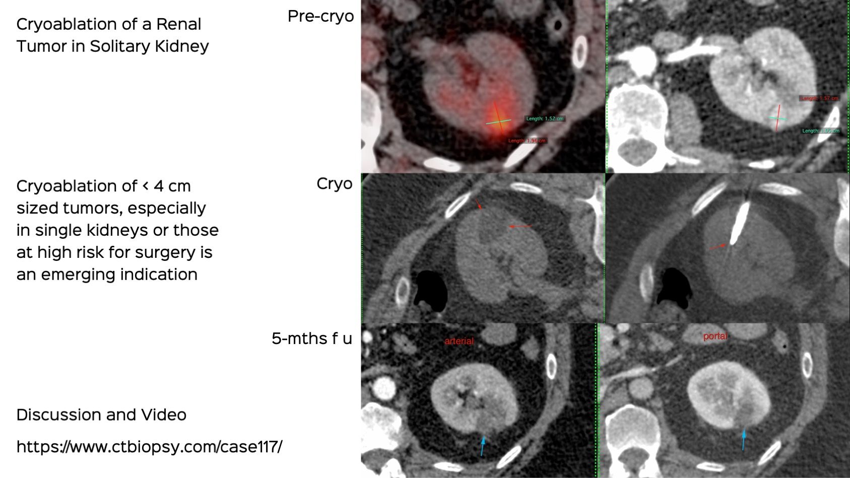 Case 117: Cryoablation of a Small Renal Tumor in a Solitary Kidney