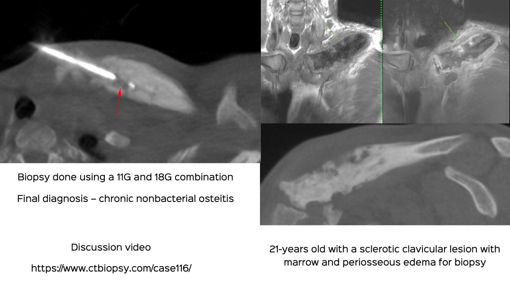 Case 116: Clavicular Lesion Biopsy