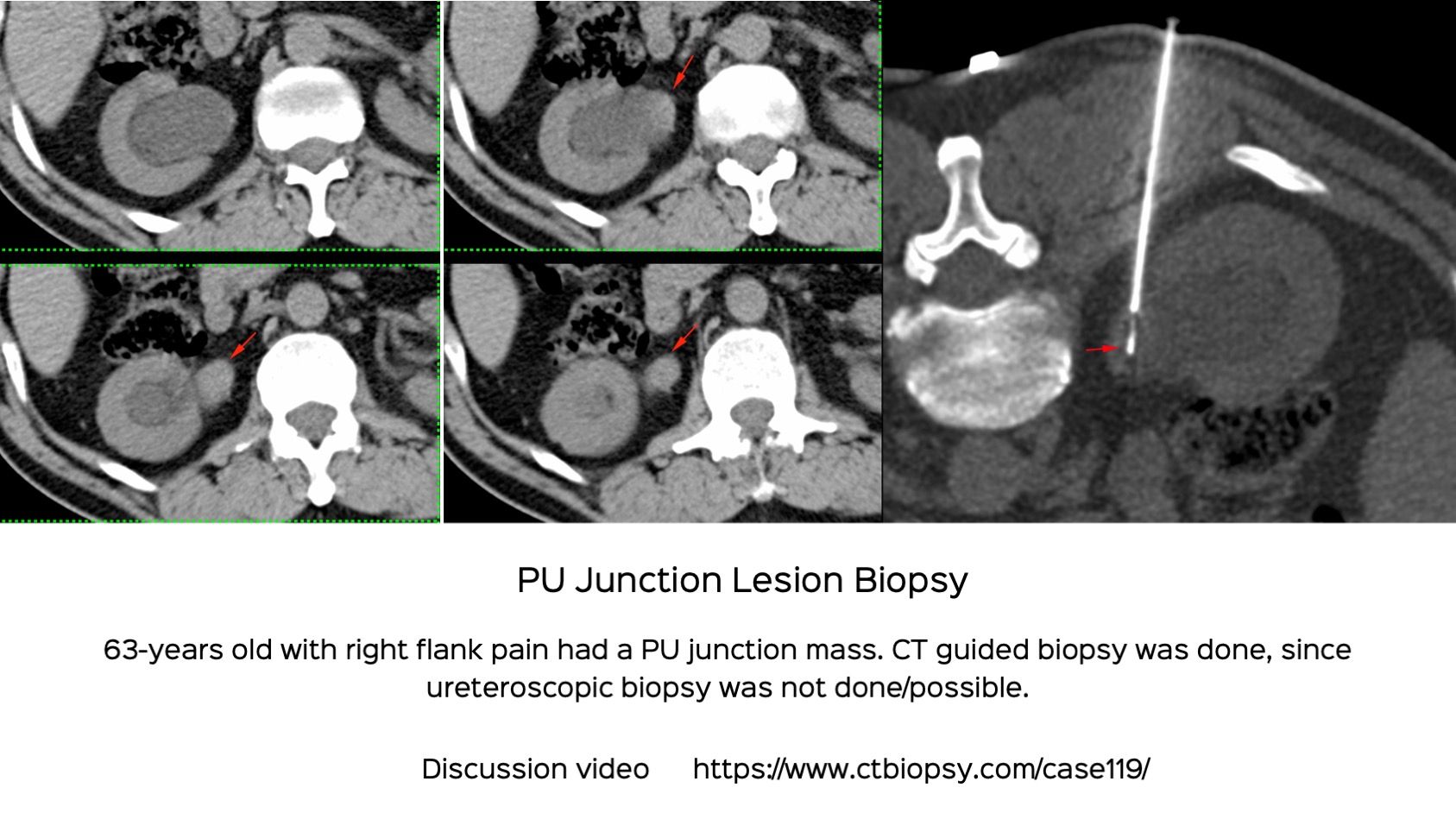 Case 119: Pelvi-Ureteric Junction (PUJ) and Medial Perirenal Perihilar Biopsies