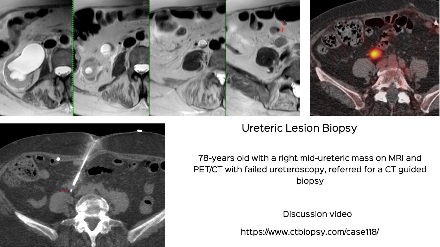 Case 118: Ureteric Lesion Biopsy