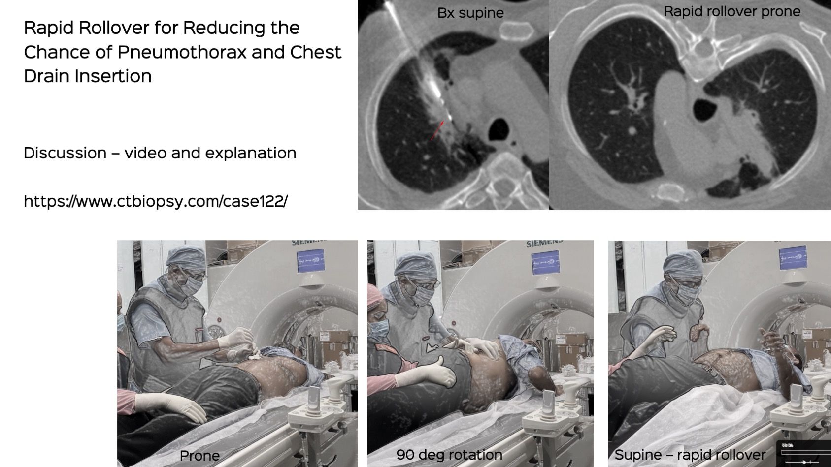 Case 122: Rapid Rollover to Reduce the Rate of  Exit Pneumothorax and Chest Drain Insertion