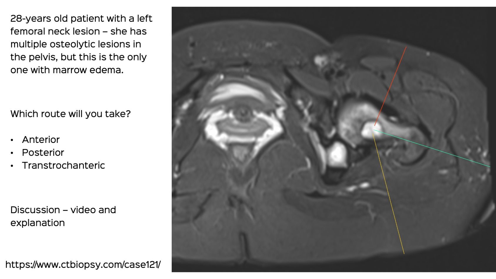 Case 121: Transtrochanteric Biopsy of a Femoral Neck Lesion