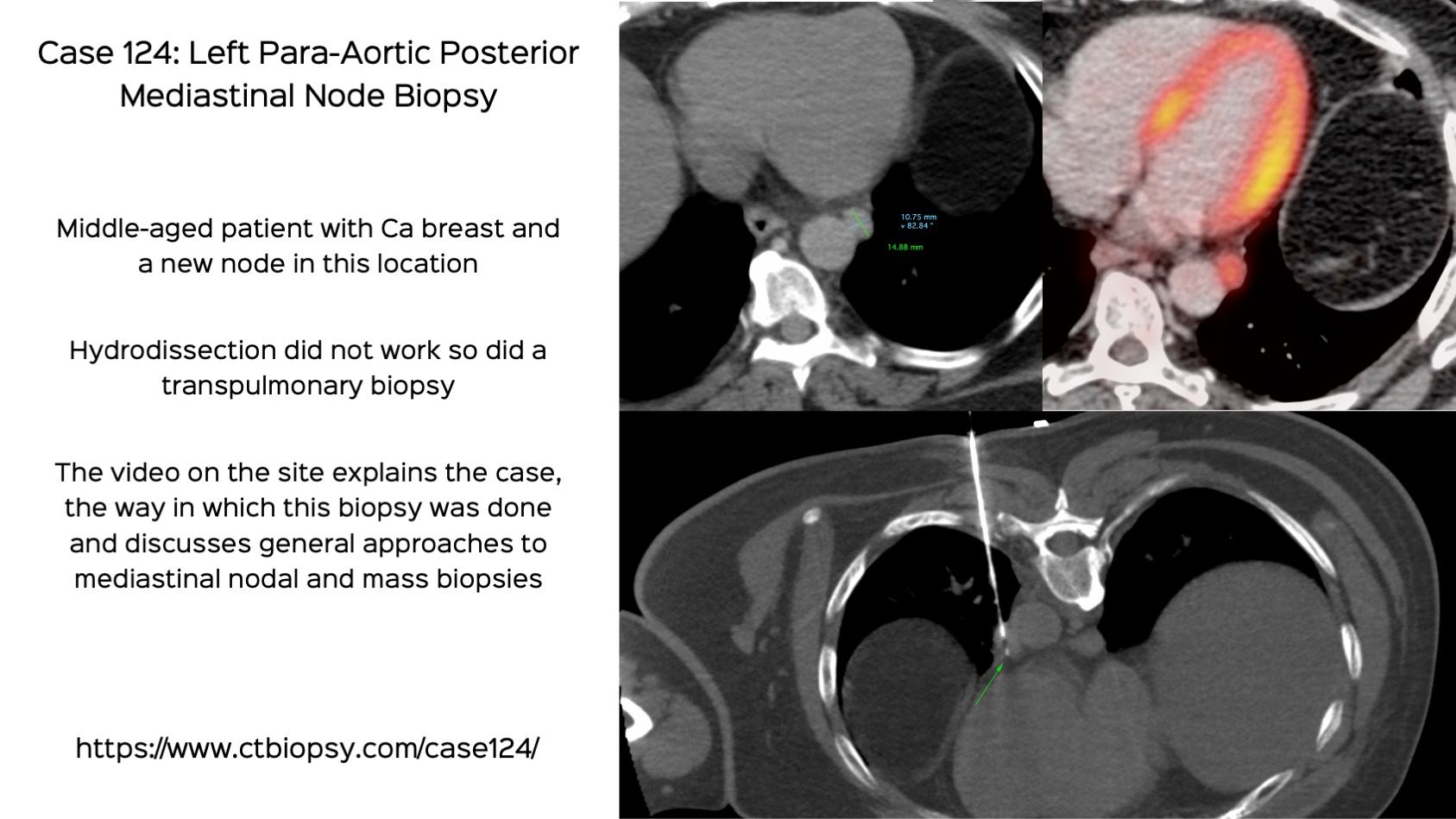 Case 124: Left Para-Aortic Posterior Mediastinal Node Biopsy