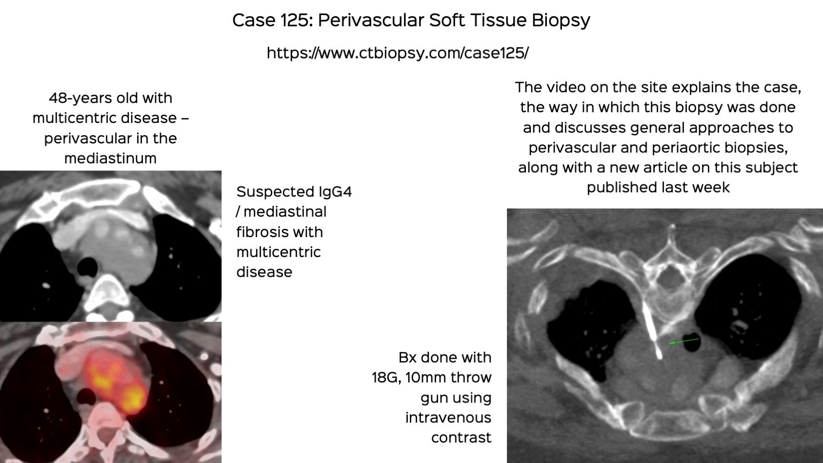 Case 125: Perivascular Soft Tissue Biopsy