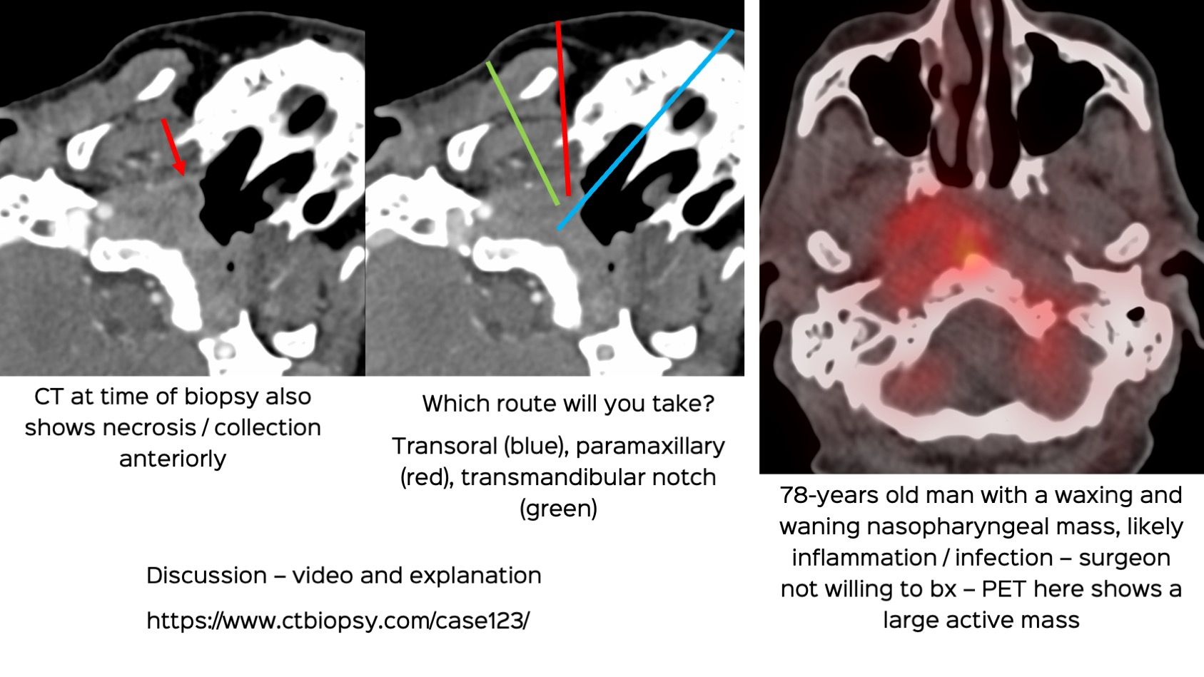 Case 123: Nasopharyngeal Mass Biopsy