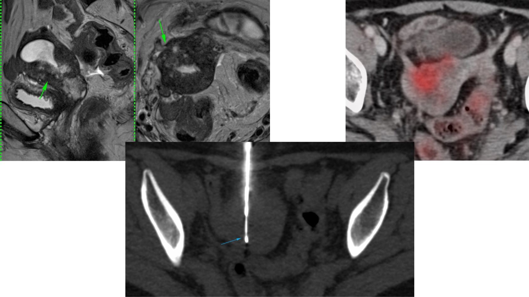 Case 126: Intra-Uterine Mass Biopsy