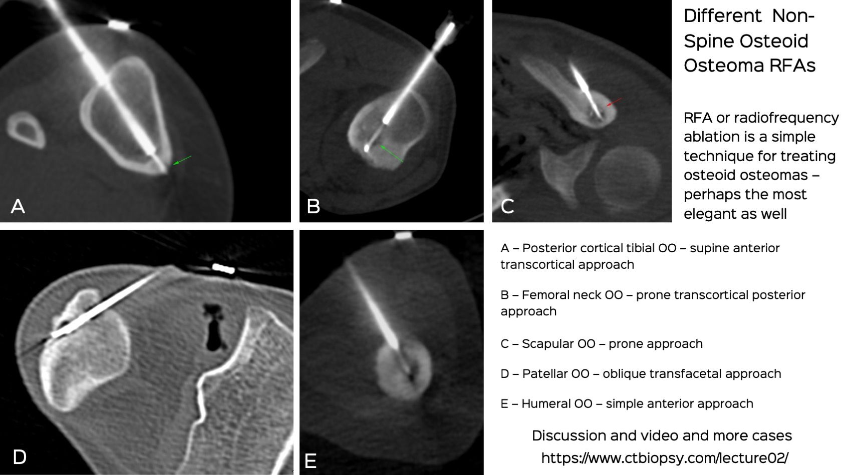 Lecture: Osteoid Osteomas - Treatment Methods Focussing on Radiofrequency Ablation (RFAs)