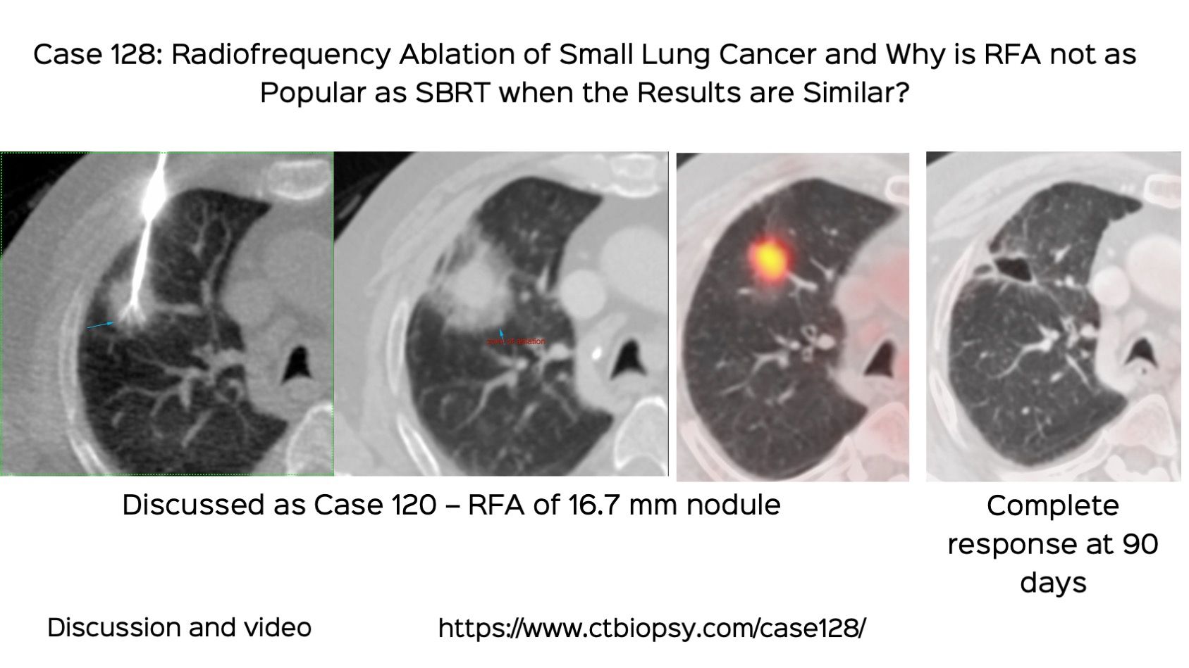 Case 128: Radiofrequency Ablation (RFA) of Small Lung Cancer...and Why is RFA not as Popular as SBRT when the Results are Similar?