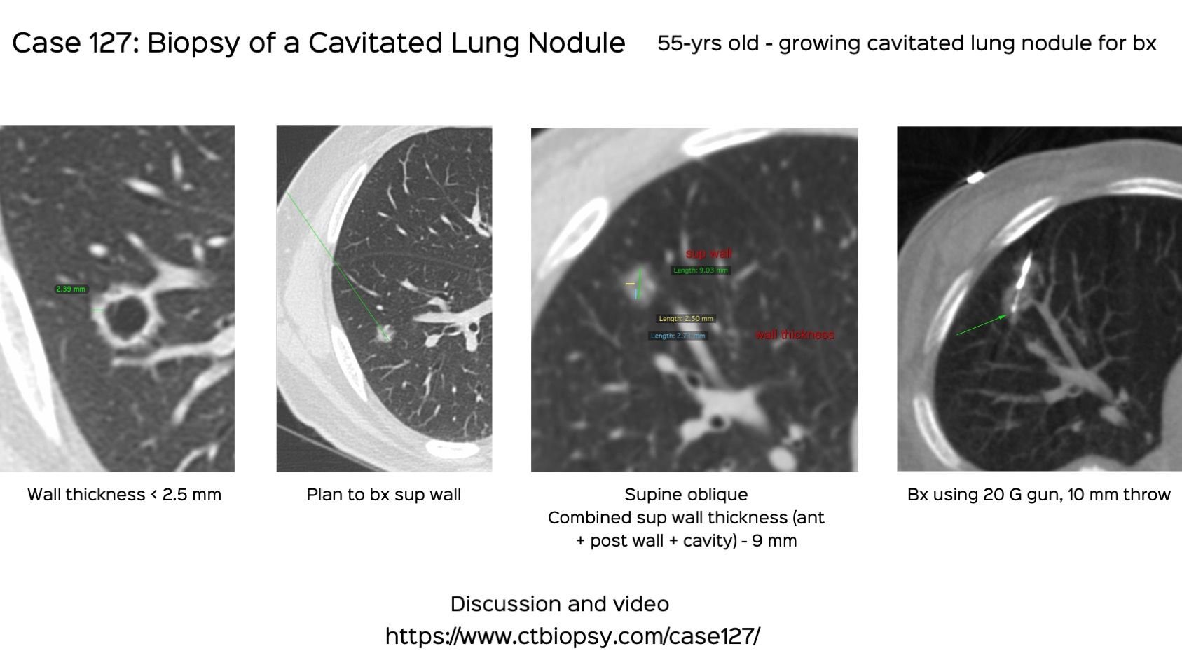 Case 127: Biopsy of a Cavitated Lung Nodule