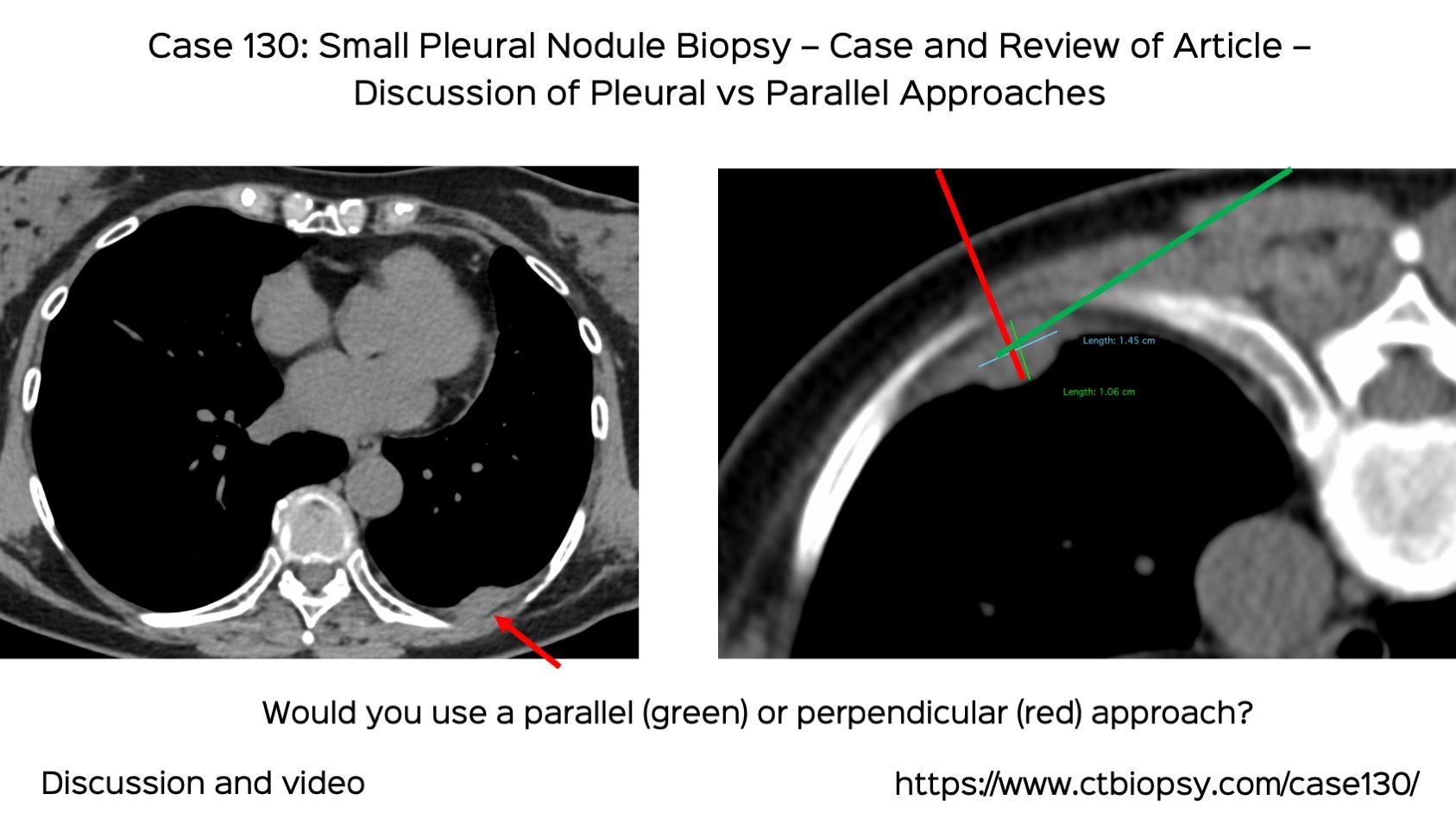 Case 130: Small Pleural Nodule Biopsy - Case and Article Review - Perpendicular vs Parallel Approaches