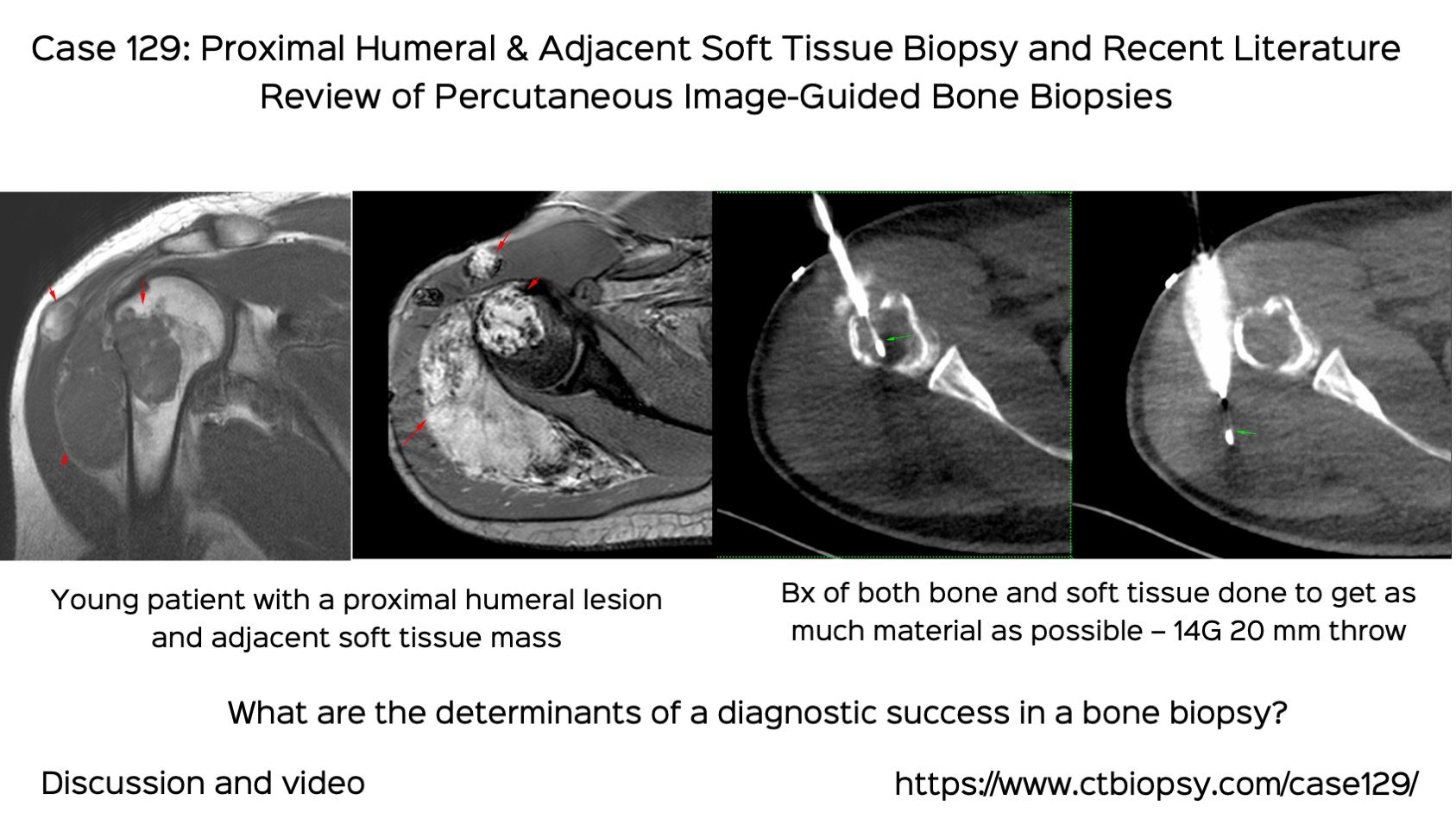 Case 129: Proximal Humerus and Adjacent Soft Tissue Biopsy (Bone and Soft Tissue) with Recent Literature Review of Bone Biopsies
