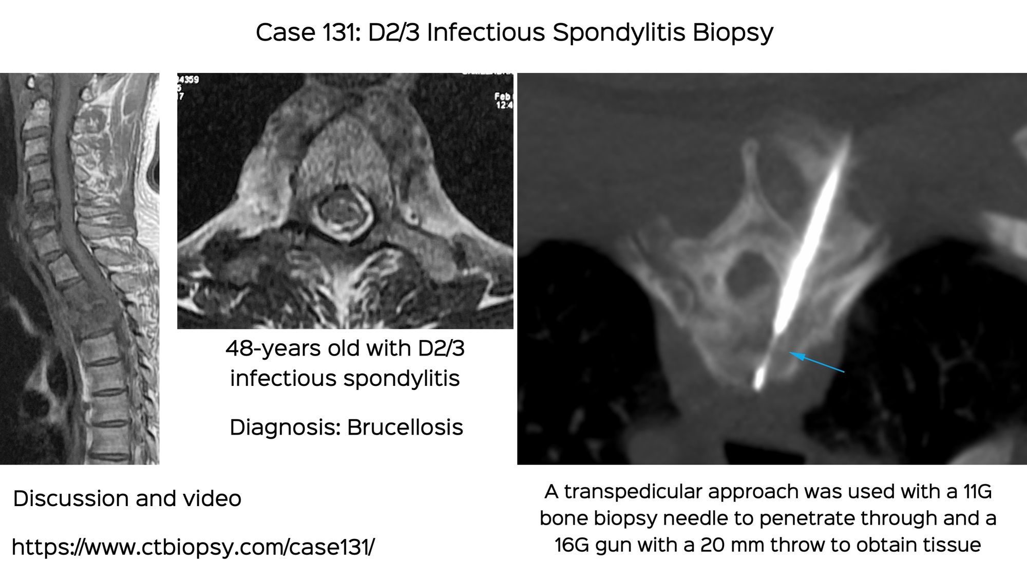 Case 131: Transpedicular Dorsal Spine Biopsy...And a Surprise Diagnosis