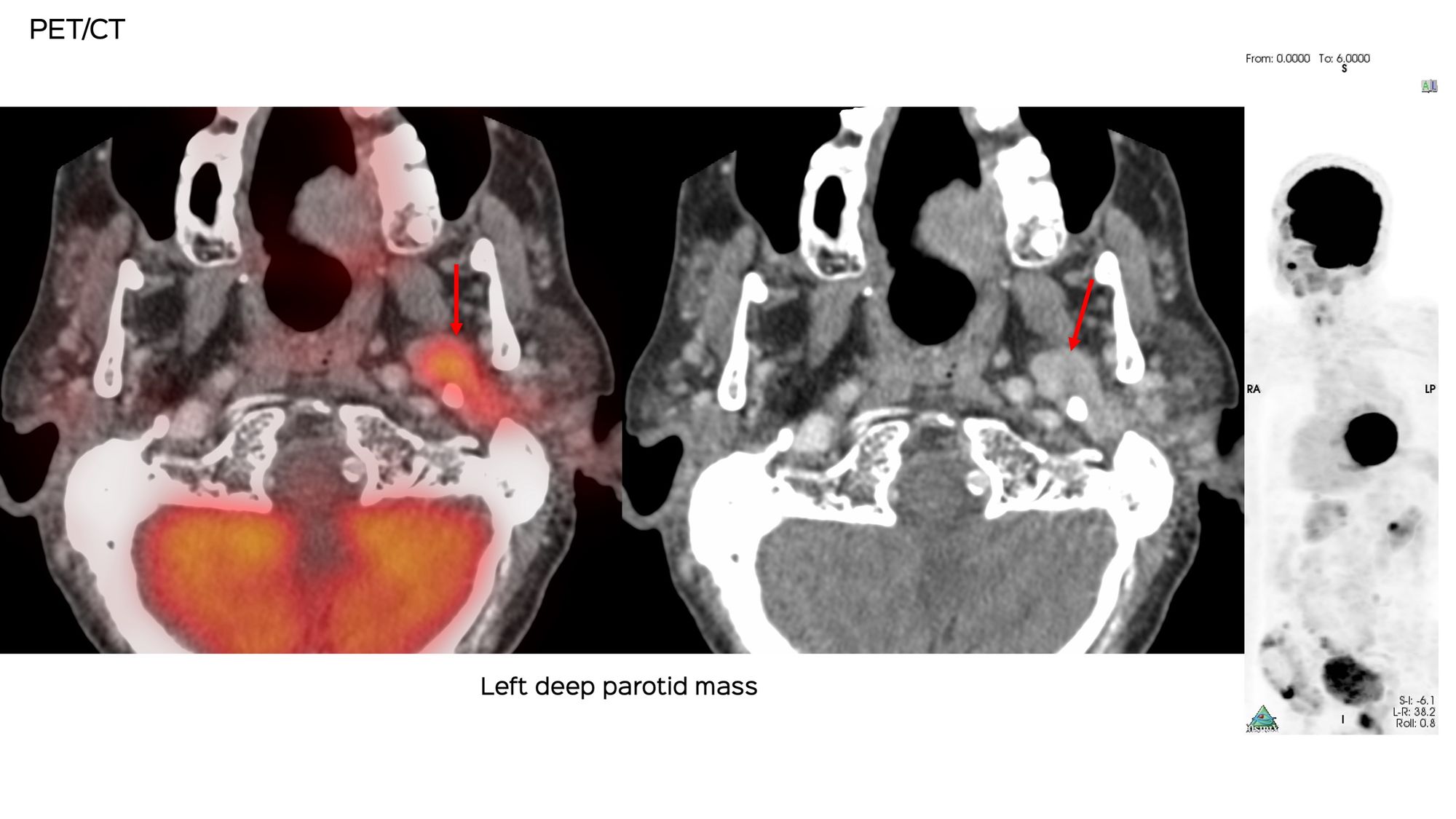 Case 133: Deep Parotid Lesion Biopsy