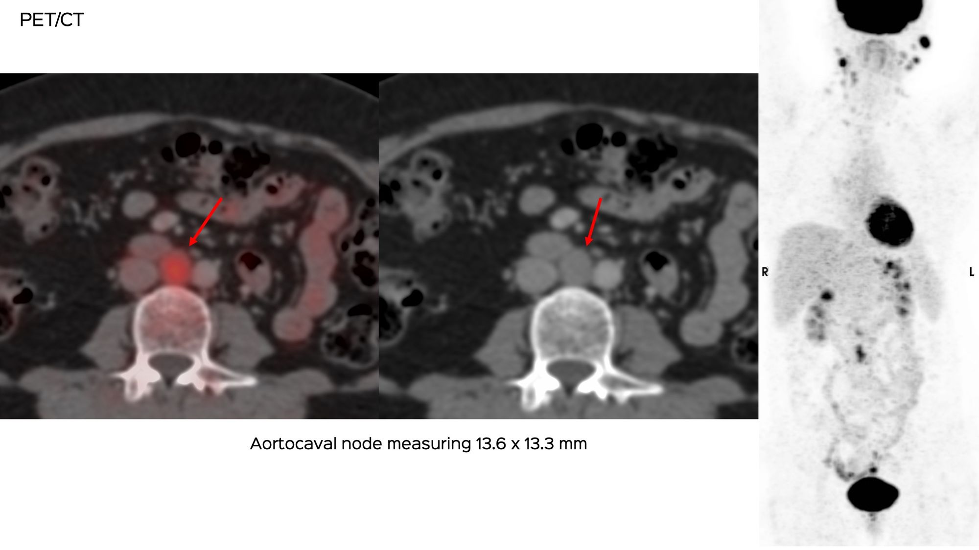 Case 134: Aortocaval Node Biopsy