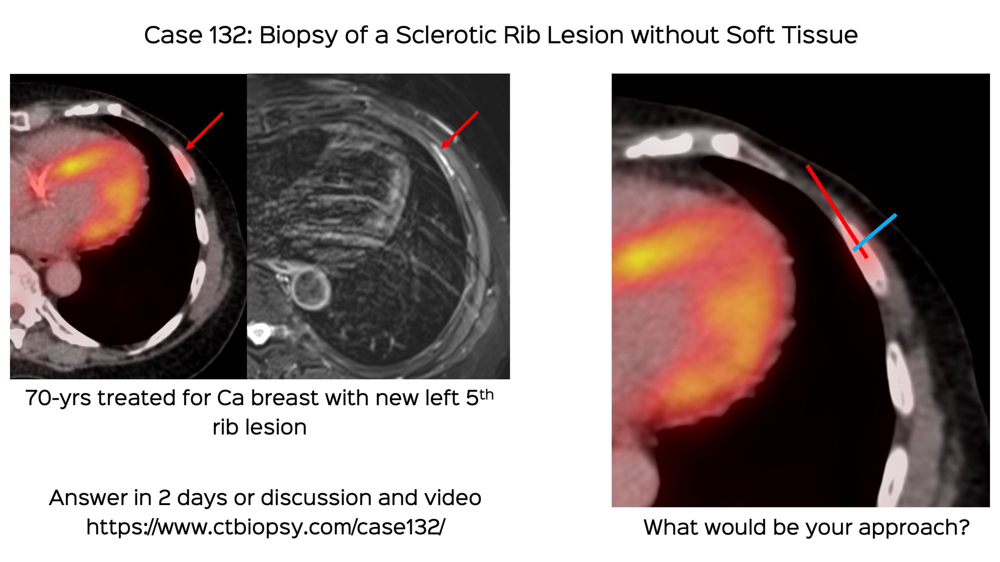 Case 132: Biopsy of a Sclerotic Rib Lesion without Soft Tissue