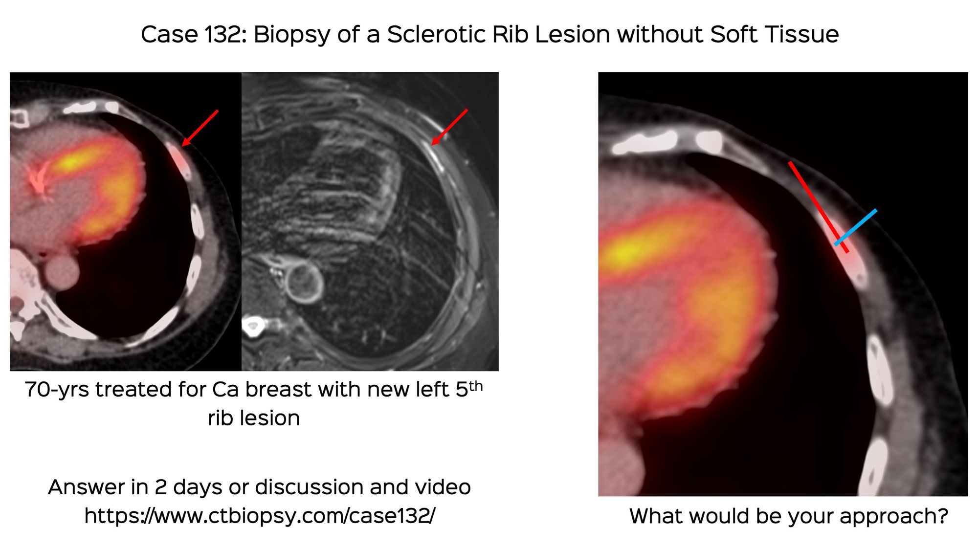 Case 133: Deep Parotid Lesion Biopsy