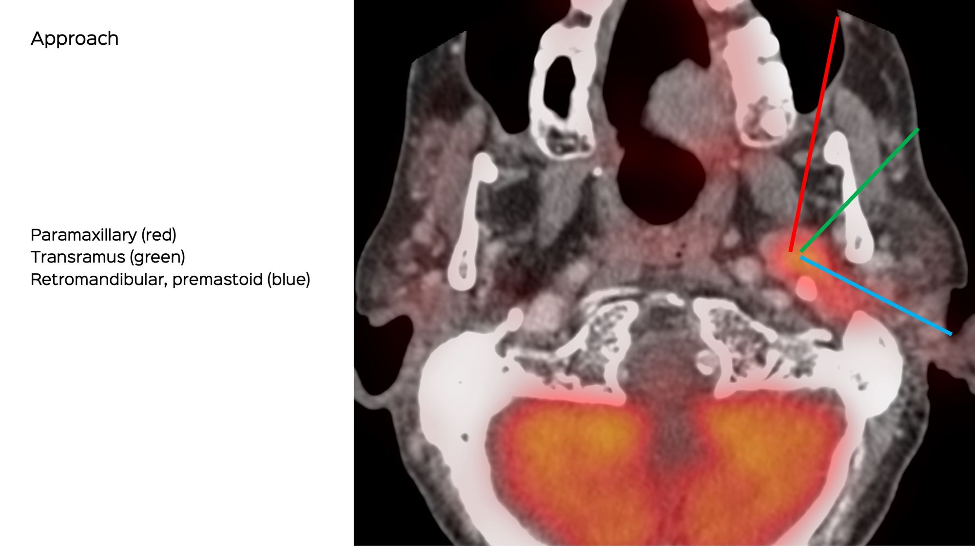 Case 133: Deep Parotid Lesion Biopsy