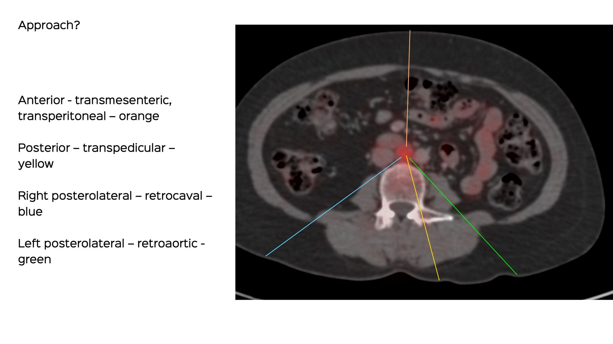 Case 134: Aortocaval Node Biopsy