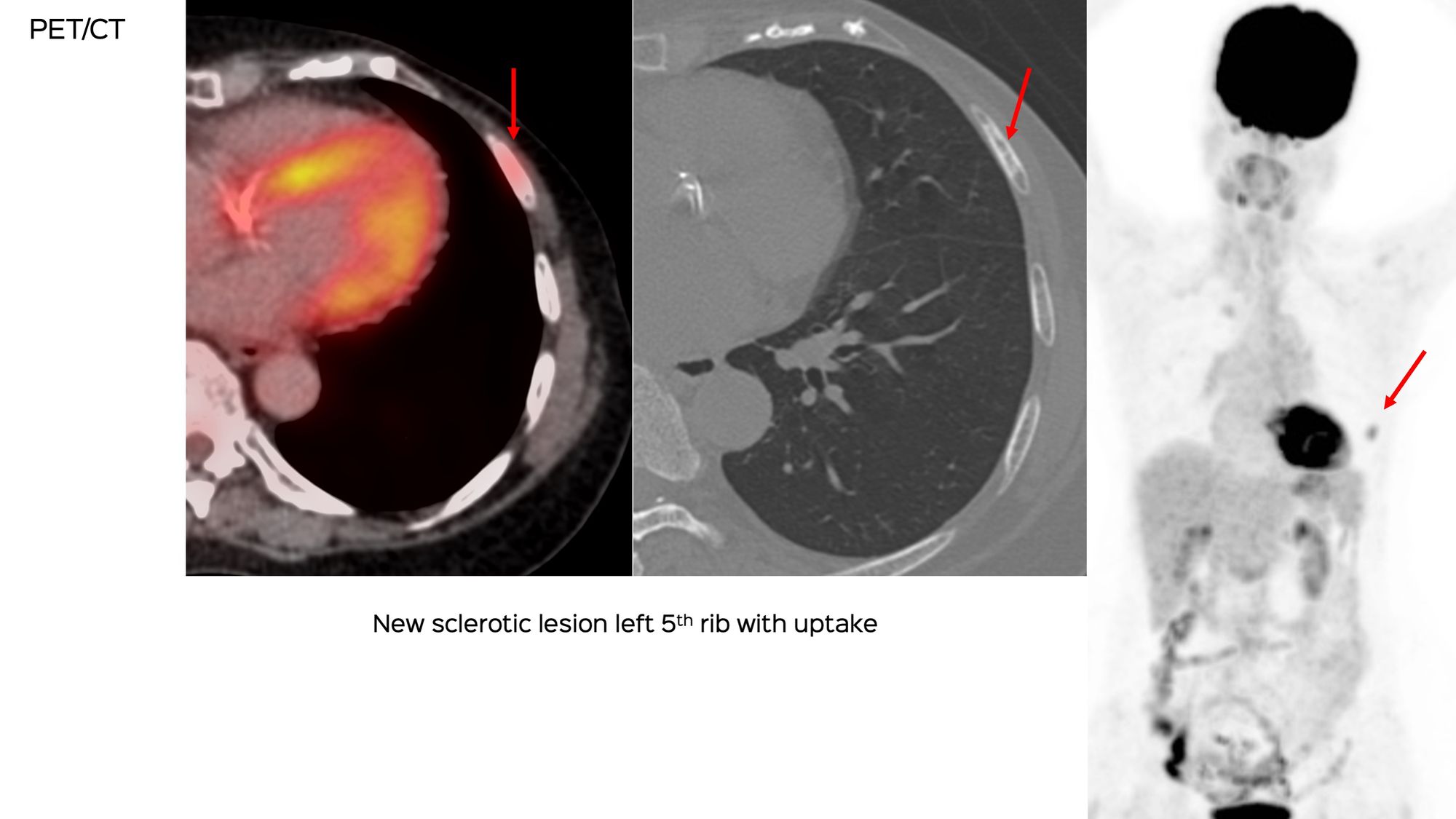 Case 132: Biopsy of a Sclerotic Rib Lesion without Soft Tissue