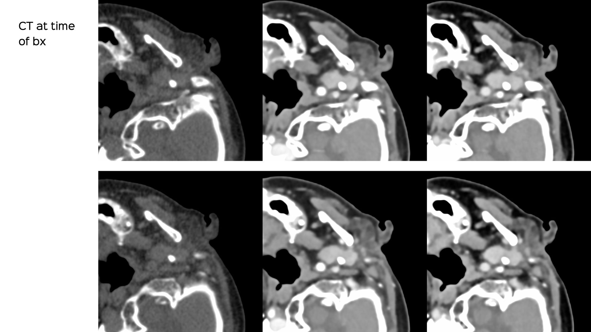 Case 133: Deep Parotid Lesion Biopsy