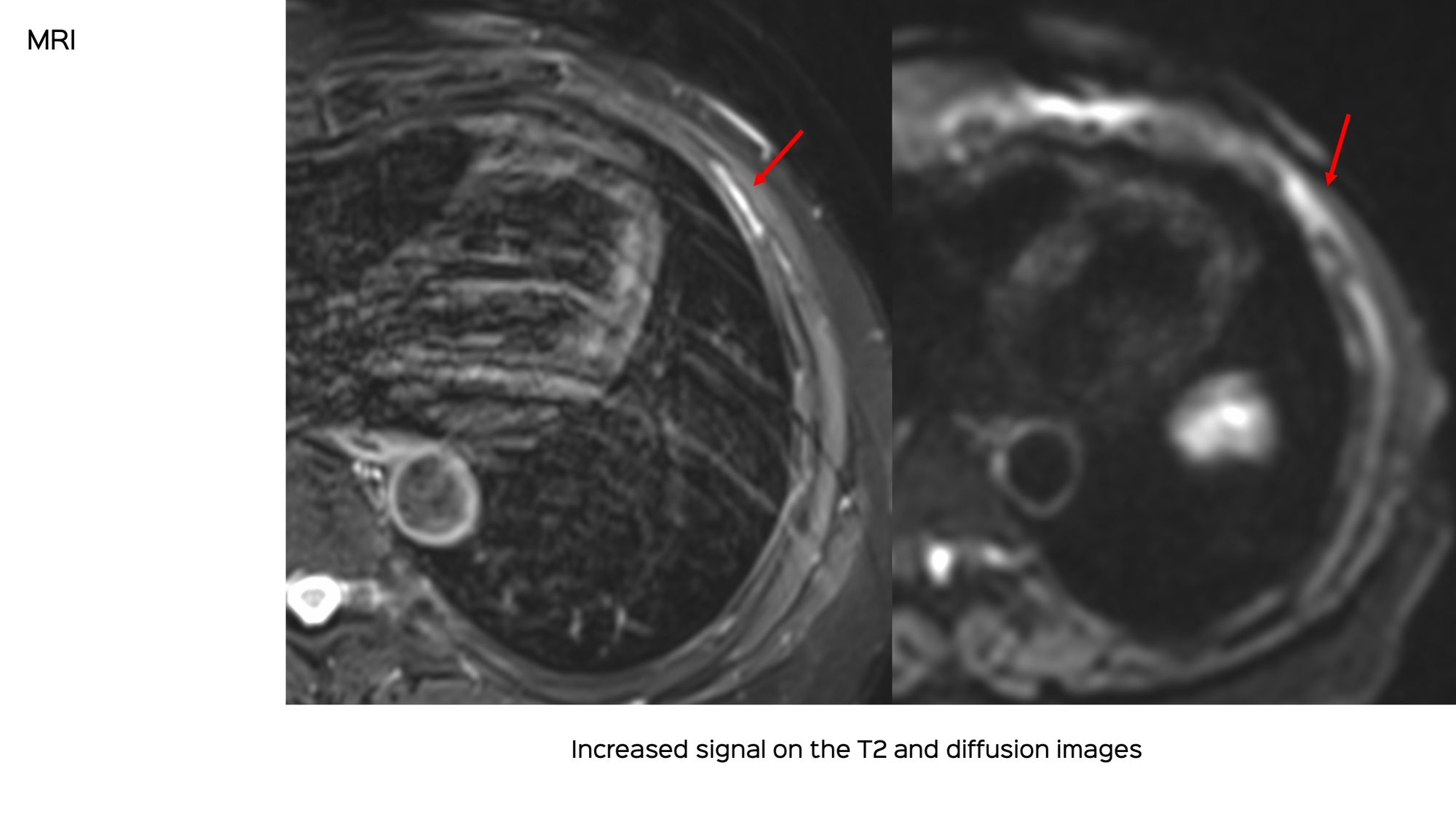 Case 132: Biopsy of a Sclerotic Rib Lesion without Soft Tissue