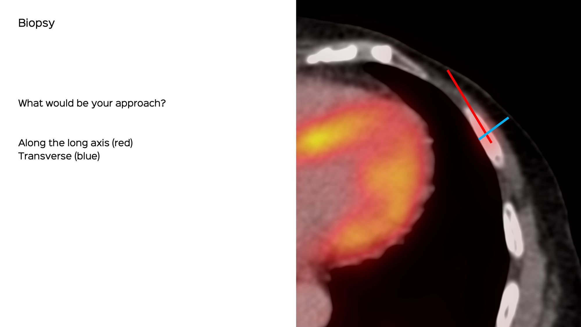 Case 132: Biopsy of a Sclerotic Rib Lesion without Soft Tissue