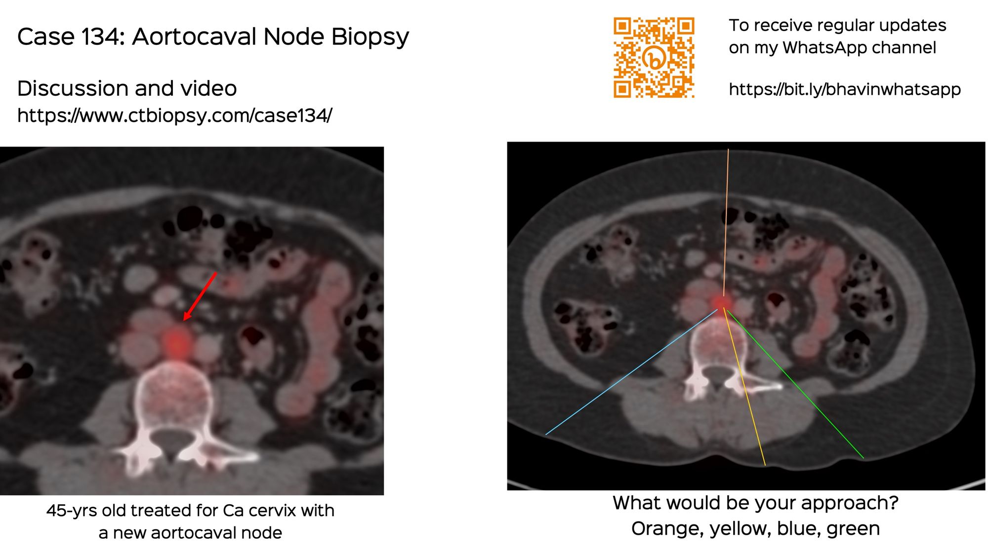 Case 134: Aortocaval Node Biopsy