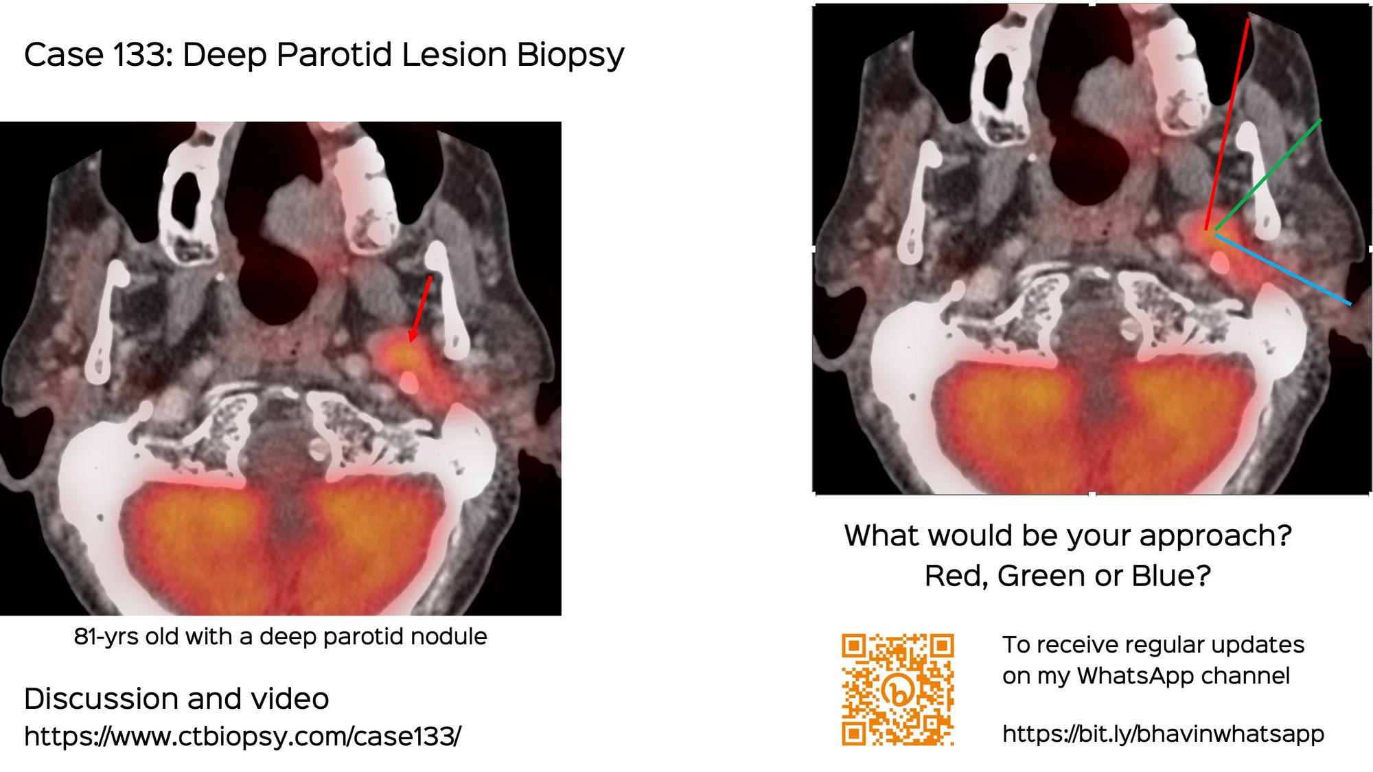 Case 133: Deep Parotid Lesion Biopsy