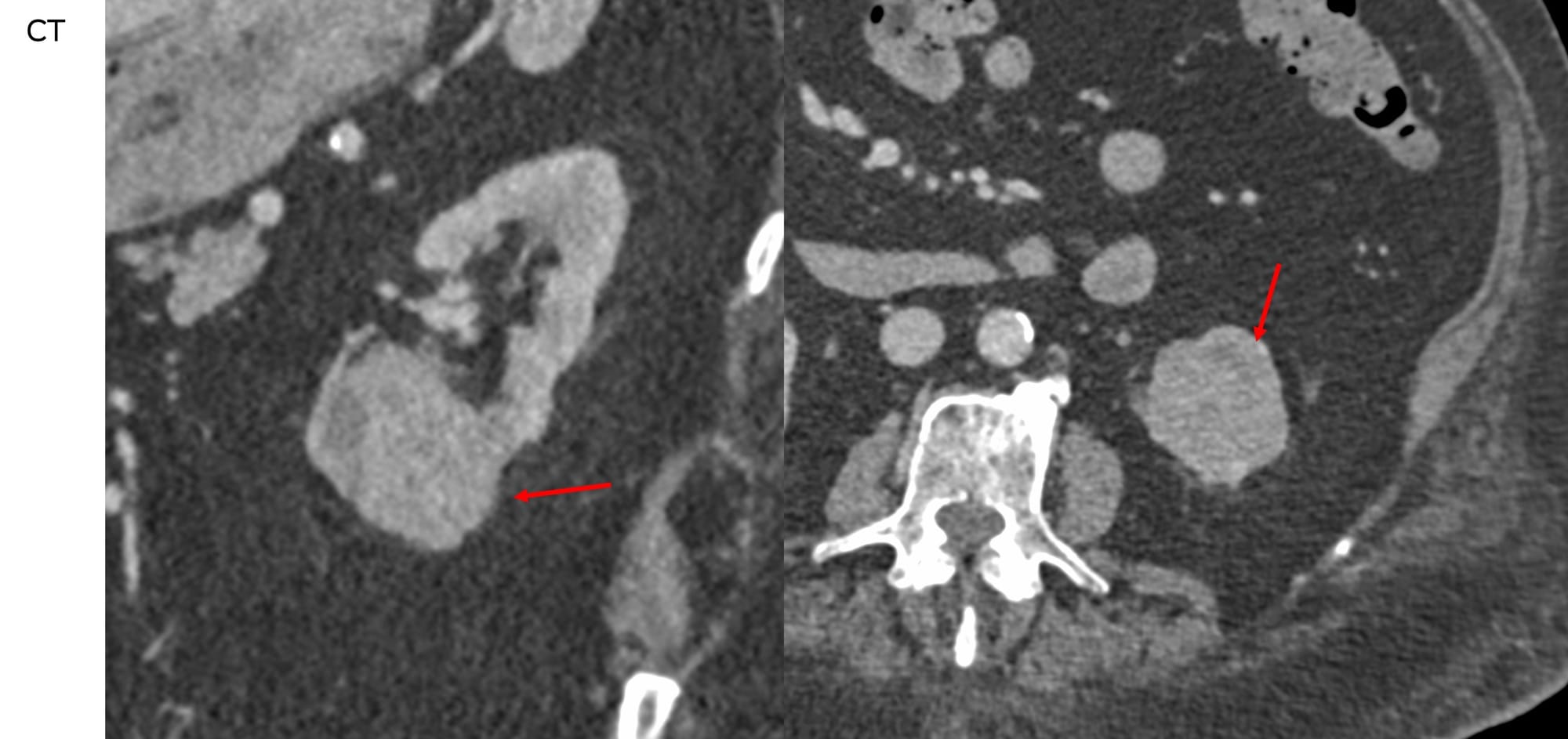 Case 135: Cryoablation of Renal Cell Carcinoma