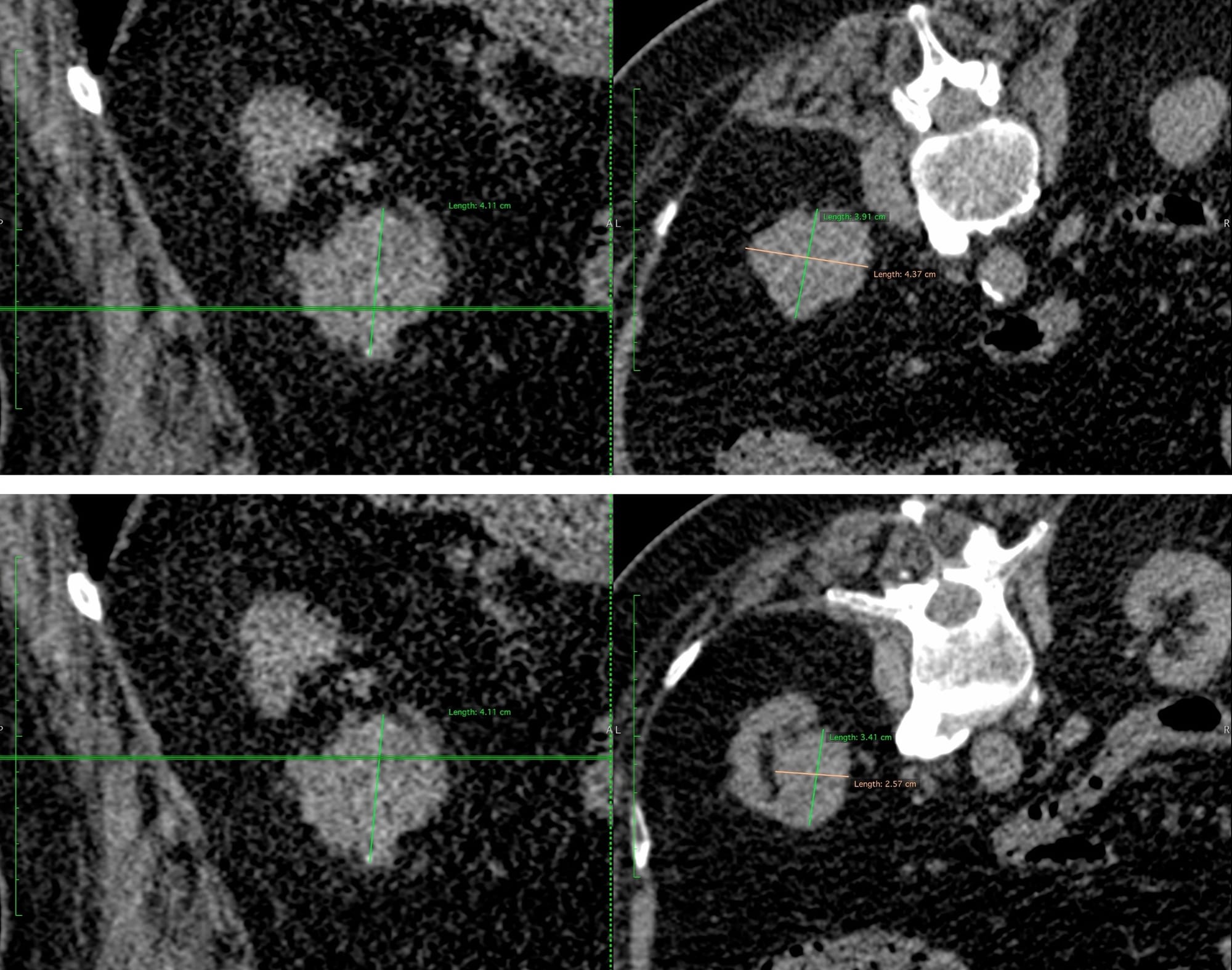 Case 135: Cryoablation of Renal Cell Carcinoma