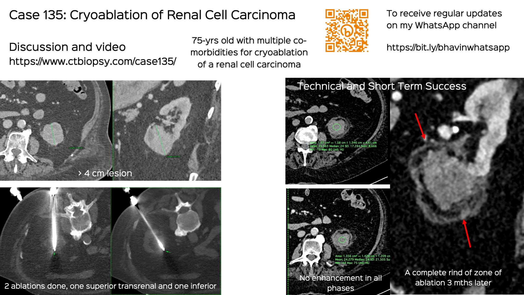 Case 135: Cryoablation of Renal Cell Carcinoma