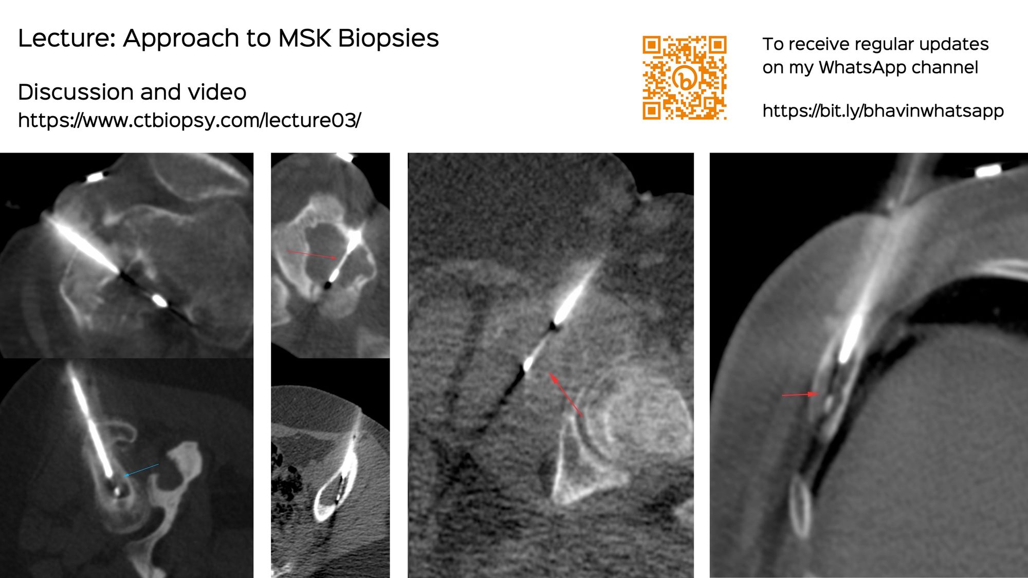 Lecture: Approach to MSK Biopsies