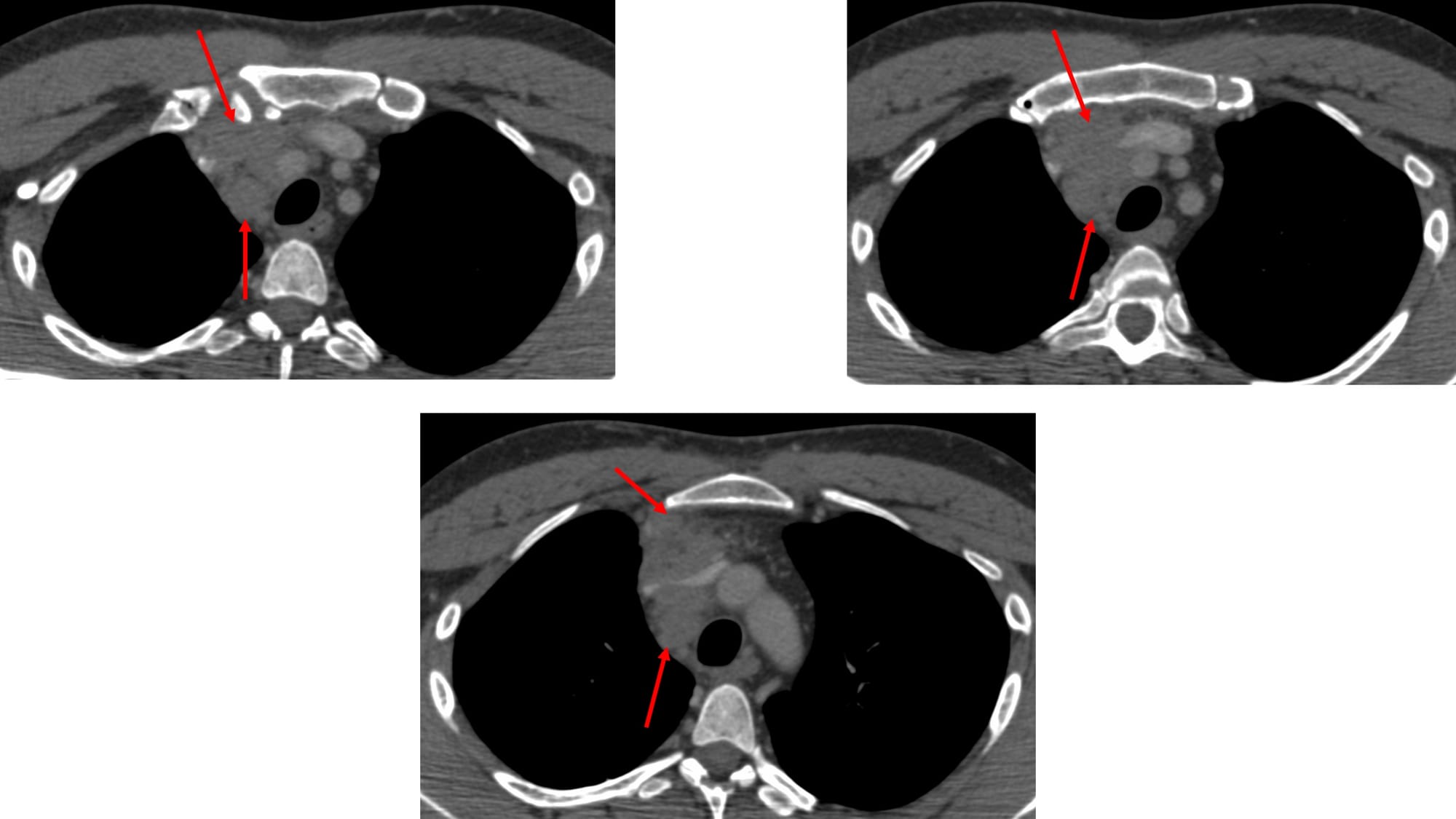 Case 137: Prevascular Space Mediastinal Lesion for Biopsy - What is Your Approach?