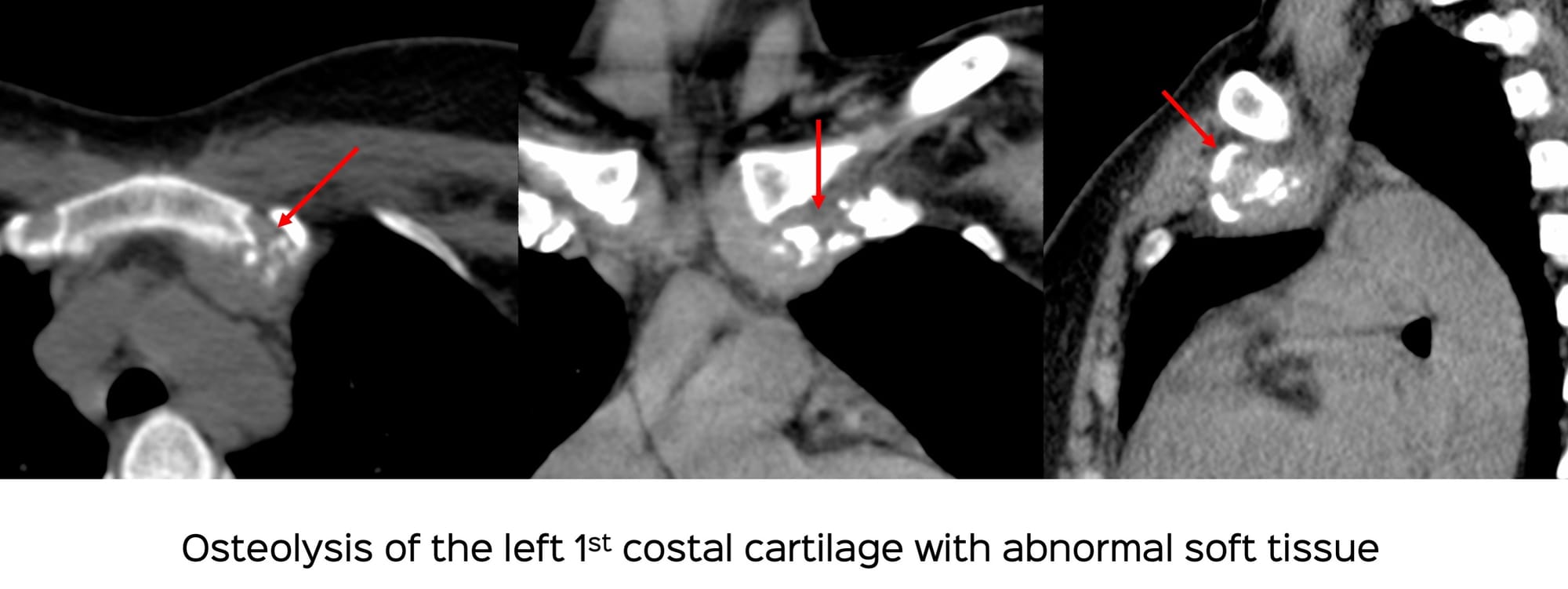 Case 136: Costal Cartilage and Costochondral Biopsy