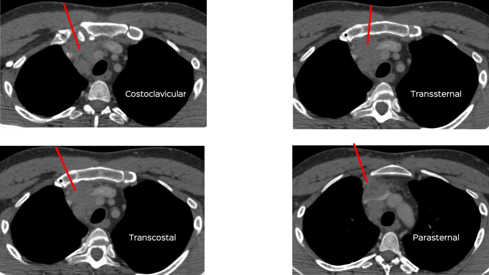 Case 137: Prevascular Space Mediastinal Lesion for Biopsy - What is Your Approach?