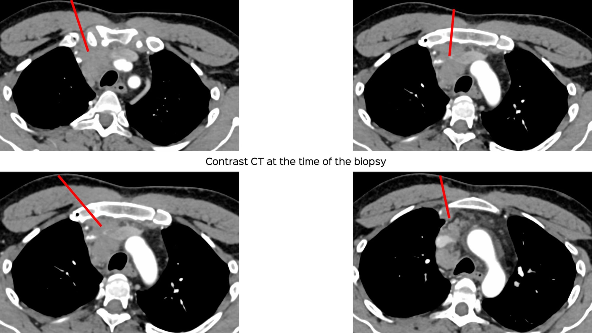 Case 137: Prevascular Space Mediastinal Lesion for Biopsy - What is Your Approach?