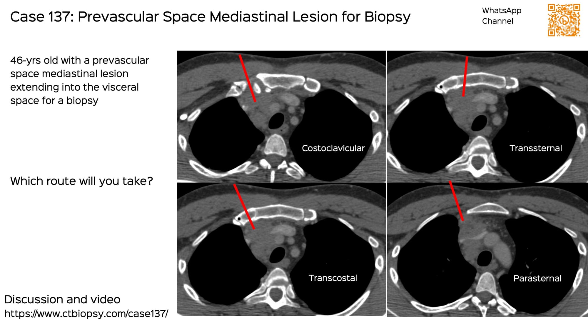 Case 137: Prevascular Space Mediastinal Lesion for Biopsy - What is Your Approach?
