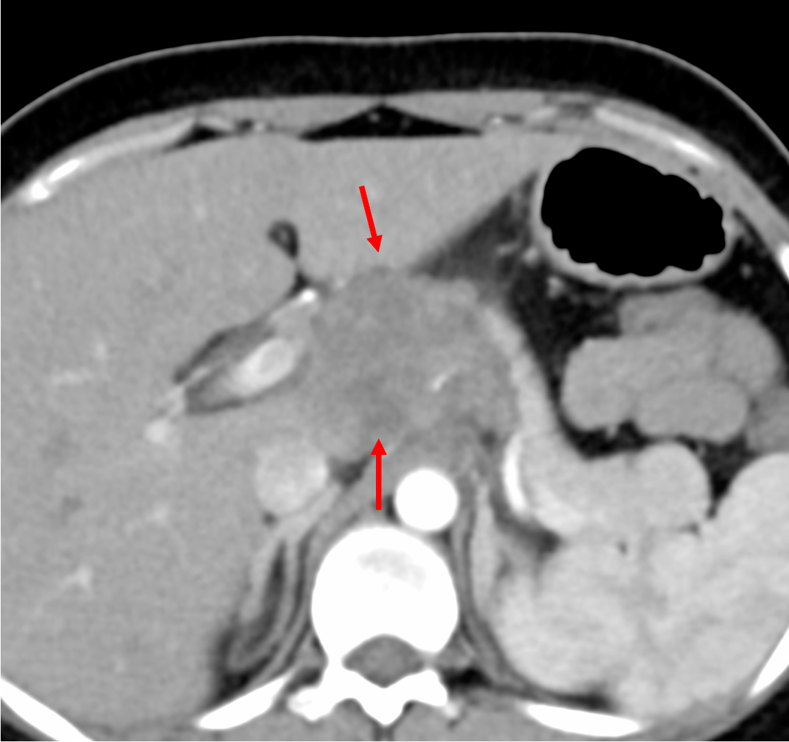 Case 138: Transhepatic Portal Node Biopsy