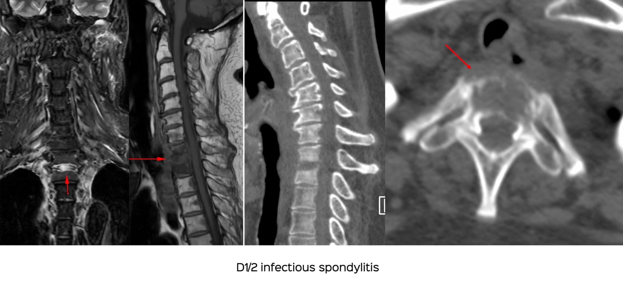 Snippet: Why Every Infectious Spondylitis Needs a Biopsy - Three Recent Unusual Spine Infections
